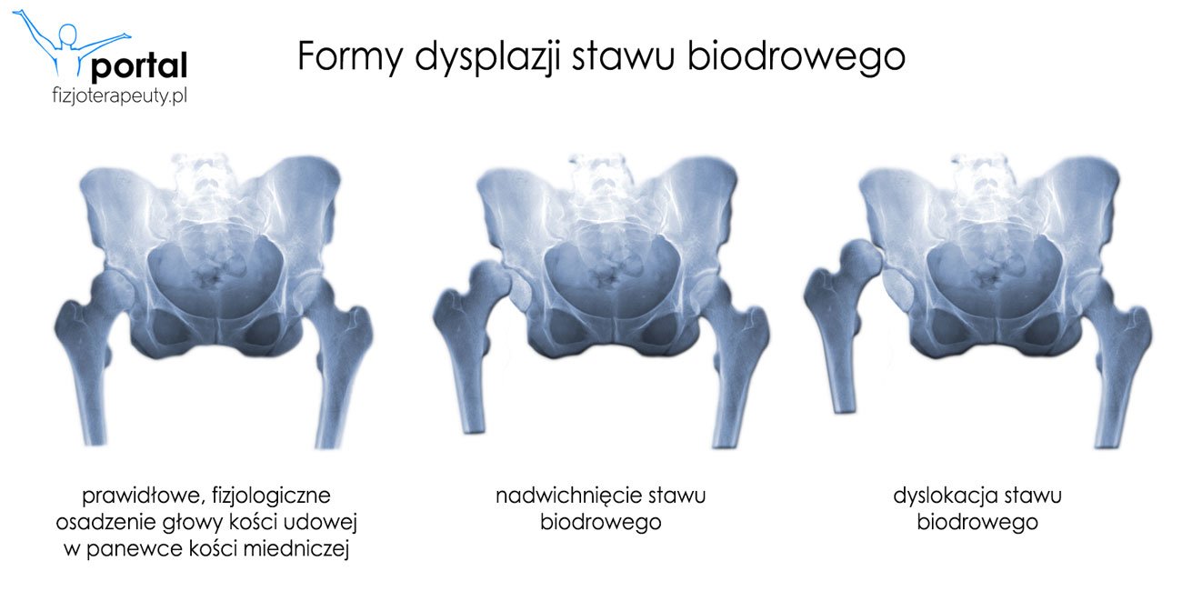 dysplazja stawu biodrowego u niemowląt a pieluchy wielorazowe