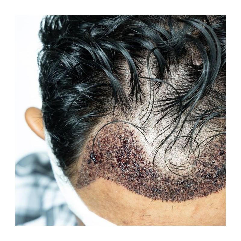 szampon do włosów po przeszczepie z procapilem