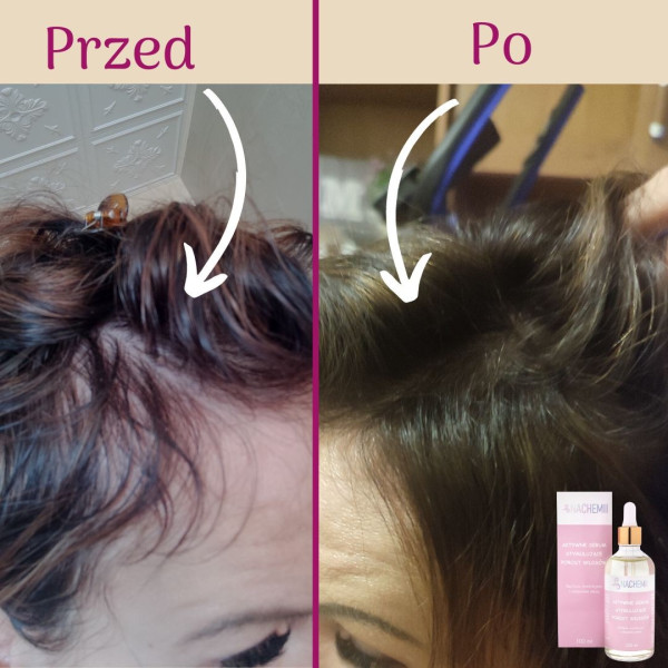 czy w czasie chemioterapi można stosować szampon na porost włosów