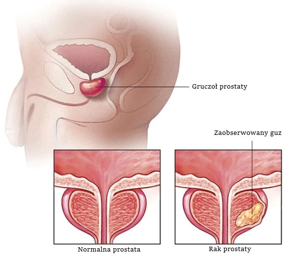 nowotwór prostaty czy należą się pieluchomajtki