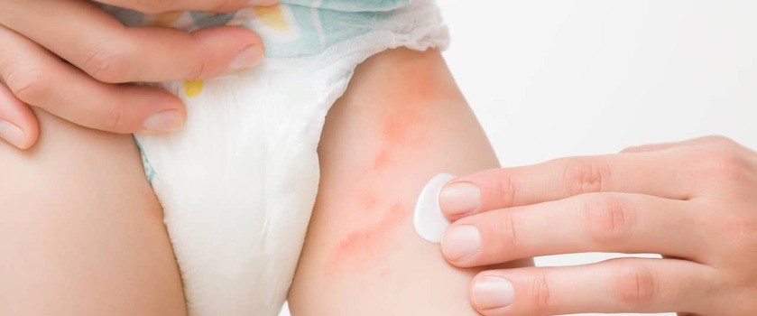 objawy alergii na pieluchy