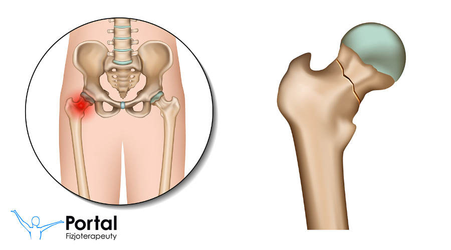 złamanie szyjki kości udowej zmiana pampersa