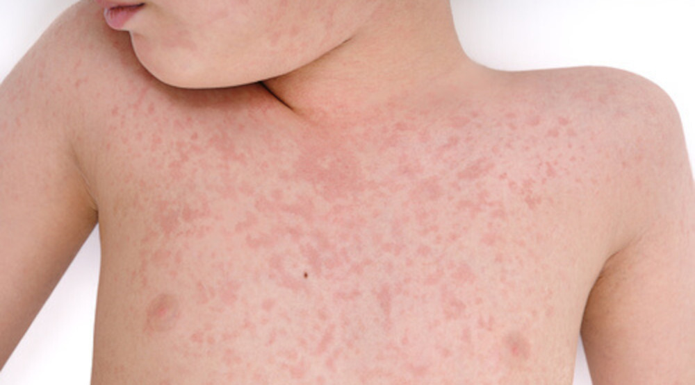 objawy alergii na pieluchy
